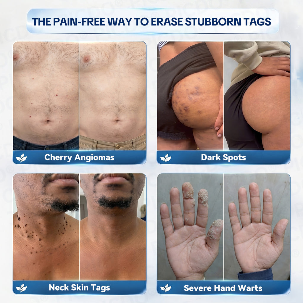 𝐏𝐢𝐜𝐝𝐨®💦7-𝐃𝐚𝐲 𝐒𝐤𝐢𝐧 𝐓𝐚𝐠 & 𝐒𝐩𝐨𝐭 𝐄𝐫𝐚𝐬𝐞𝐫 𝐂𝐫𝐞𝐚𝐦(Zero Pain, Zero 𝐒𝐜𝐚𝐫𝐬 Formula)🌺