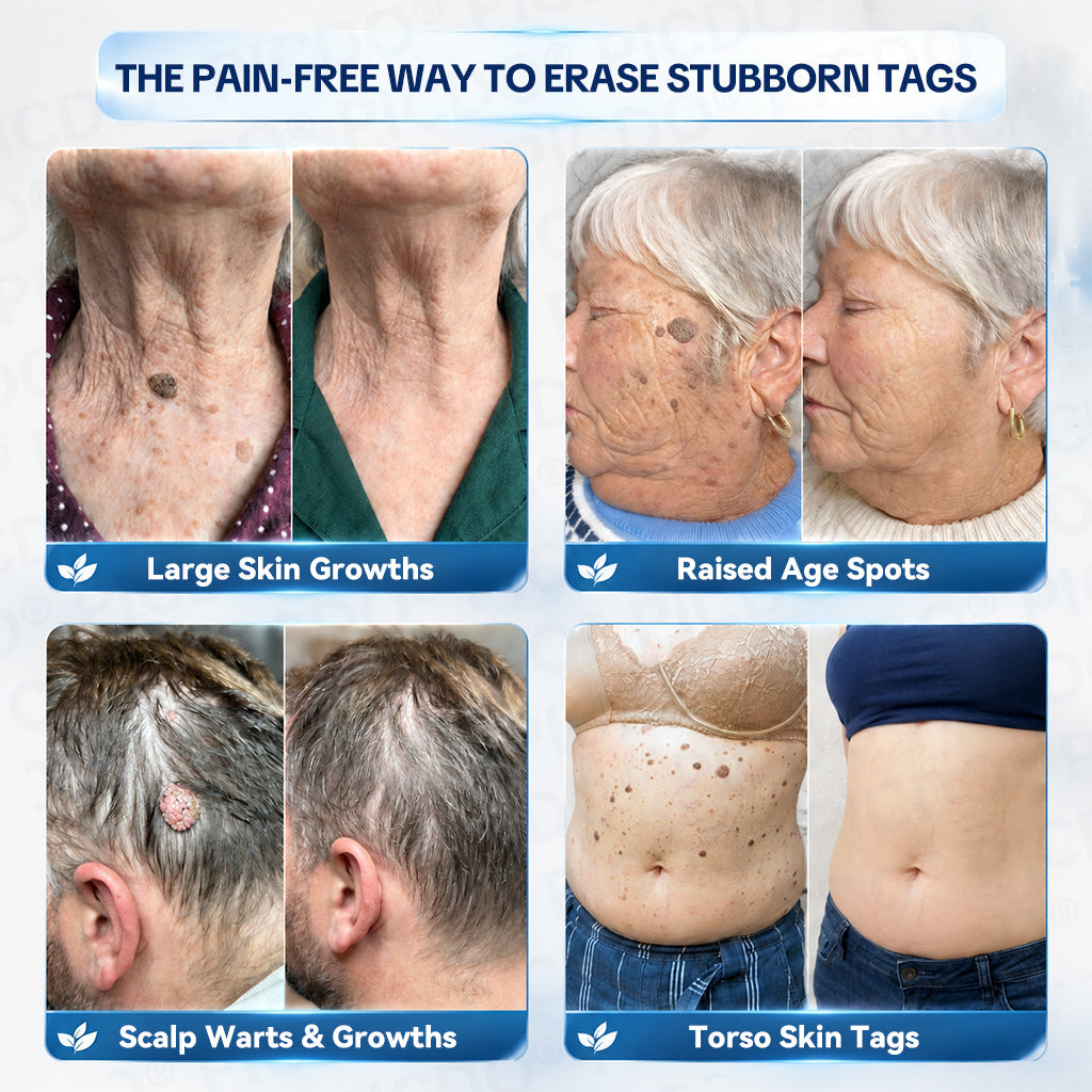 𝐏𝐢𝐜𝐝𝐨®💦7-𝐃𝐚𝐲 𝐒𝐤𝐢𝐧 𝐓𝐚𝐠 & 𝐒𝐩𝐨𝐭 𝐄𝐫𝐚𝐬𝐞𝐫 𝐂𝐫𝐞𝐚𝐦(Zero Pain, Zero 𝐒𝐜𝐚𝐫𝐬 Formula)🌺