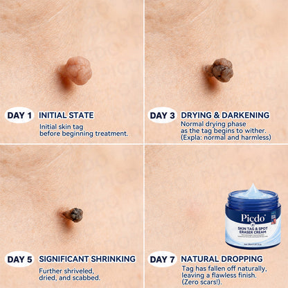 𝐏𝐢𝐜𝐝𝐨®💦7-𝐃𝐚𝐲 𝐒𝐤𝐢𝐧 𝐓𝐚𝐠 & 𝐒𝐩𝐨𝐭 𝐄𝐫𝐚𝐬𝐞𝐫 𝐂𝐫𝐞𝐚𝐦(Zero Pain, Zero 𝐒𝐜𝐚𝐫𝐬 Formula)🌺