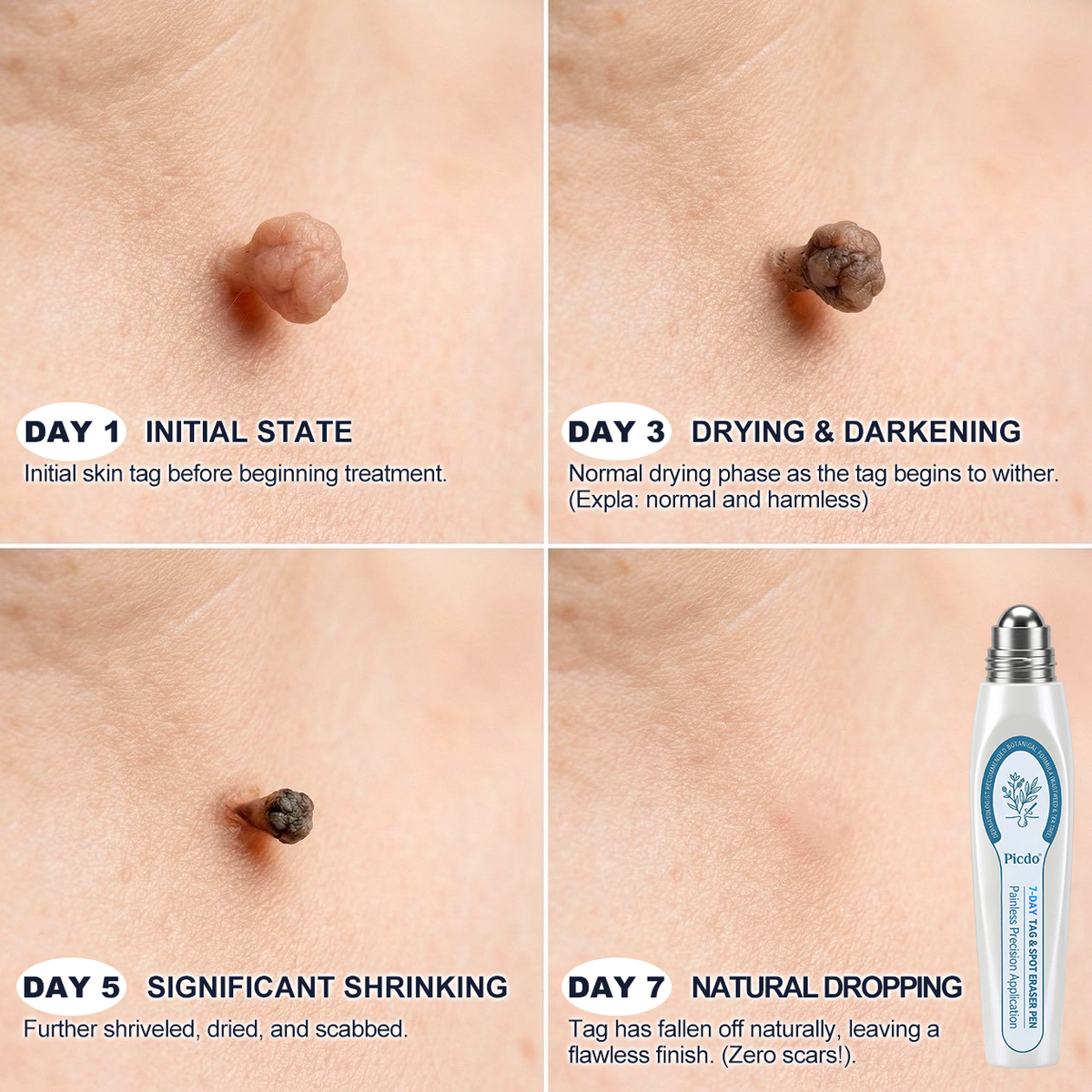 𝐏i𝐜𝐝o® 7-𝐷𝑎𝑦 𝗧𝐚𝐠 & 𝗦𝗽𝐨𝐭 𝐄𝐫𝒂𝒔𝒆𝒓(Zero Pain, Zero 𝐒𝐜𝐚𝒓𝒔 Rollerball) 🌹🌹